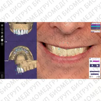 Exocad Smile Creator модуль для планирования улыбки
