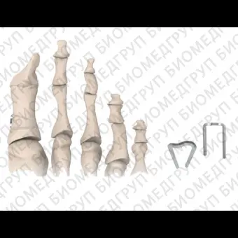Скоба для остеосинтеза артродез межфалангового сустава ноги MEMORY