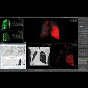 Модуль программного обеспечения для рентгенологии Myrian XPLung