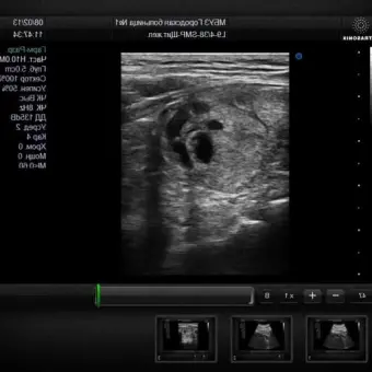 UltraSonix SonixSP Аппарат УЗИ