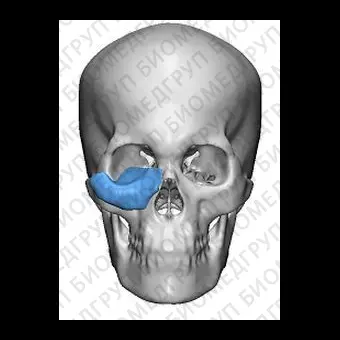 Имплантат параорбитальной области на заказ TnR PSI