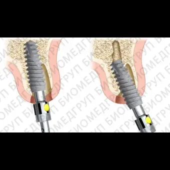 Конический зубной имплантат NobelActive