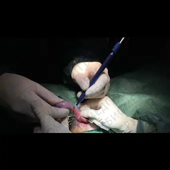 Лазер для ветеринарной хирургии LUMIX SURGERY VETERINARY