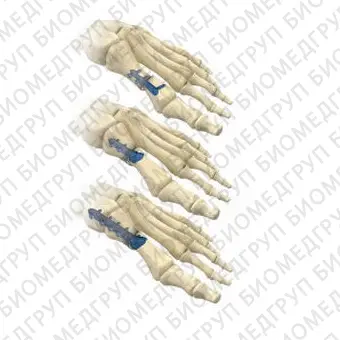 Костная пластина для остеотомии искривление большого пальца стопы наружу Multifix Lower