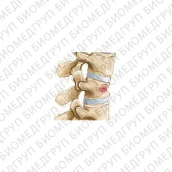 Устройство PCD для чрескожной вертебропластики 11 G, 4 шт. в уп.