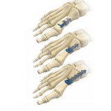 Костная пластина для остеотомии искривление большого пальца стопы наружу Multifix Lower