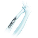 Костная пластина для остеотомии локтевая кость LCP™ 2.7