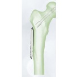 Компрессионная костная пластина для головки бедренной кости DHS